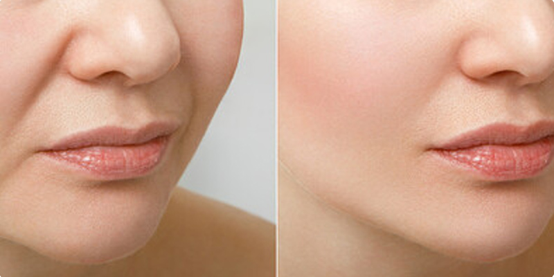 Anti-Wrinkle